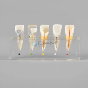 Modelo clínico de la enfermedad pulpar dental. Diferentes fases del tratamiento de curación de endodoncia