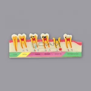 Modelo de demostración caries en desarrollo