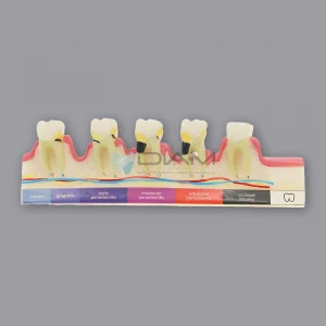 Modelo de desarrollo de enfermedades periodontales