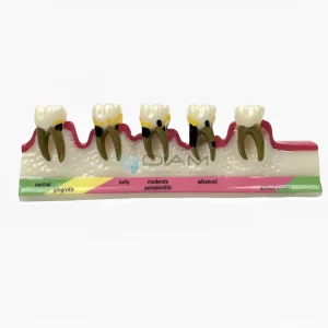 Modelo de demostración de enfermedad periodontal