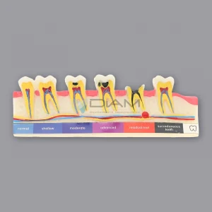 Modelo de demostración del desarrollo de caries