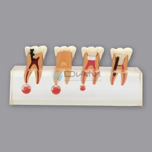 Modelo de demostración de tratamiento de endodoncia